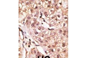 Formalin-fixed and paraffin-embedded human cancer tissue reacted with the primary antibody, which was peroxidase-conjugated to the secondary antibody, followed by DAB staining. (IL29 antibody  (AA 54-85))