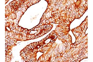 Formalin-fixed, paraffin-embedded human Colon Carcinoma stained with Cytokeratin 8/18 Monoclonal Antibody (KRT8/803 + KRT18/835). (KRT8, KRT18 antibody)