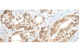 Immunohistochemistry of paraffin-embedded Human colorectal cancer tissue using ZNF83 Polyclonal Antibody at dilution of 1:50(x200) (ZNF83 antibody)