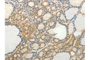 The image on the left is immunohistochemistry of paraffin-embedded Human thyroid cancer tissue using ABIN7192532(SLC9A3 Antibody) at dilution 1/20, on the right is treated with synthetic peptide. (SLC9A3 antibody)