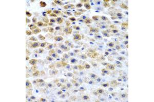 Immunohistochemistry of paraffin-embedded human liver cancer using TFPI2 antibody (ABIN5975010) at dilution of 1/200 (40x lens). (TFPI2 antibody)