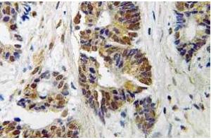 Immunohistochemistry (IHC) analyzes of GRK 2 antibody in paraffin-embedded human colon carcinoma tissue. (GRK2 antibody)