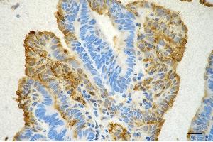 Immunohistochemistry was performed on paraffin-embedded human endometrial carcinoma using annexin A1 antibody (ABIN7797614), 1:200).