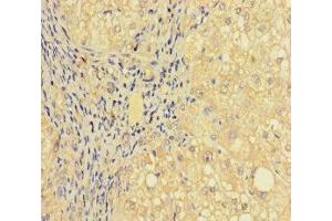 Immunohistochemistry of paraffin-embedded human liver cancer using ABIN7164277 at dilution of 1:100 (PRICKLE4 antibody  (AA 1-240))