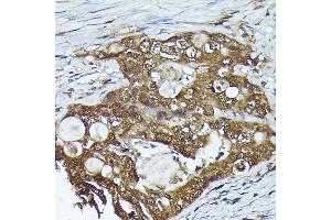 Immunohistochemistry of paraffin-embedded human colon carcinoma using FERMT2 Rabbit pAb (ABIN6131926, ABIN6140582, ABIN6140583 and ABIN6224757) at dilution of 1:300 (40x lens). (FERMT2 antibody  (AA 380-550))