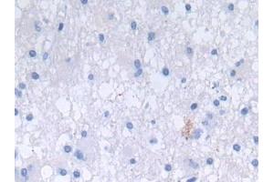 Detection of DEFa3 in Human Glioma Tissue using Polyclonal Antibody to Defensin Alpha 3, Neutrophil Specific (DEFa3) (DEFa3 antibody  (AA 21-94))