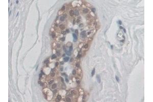 Detection of CD300c in Human Breast cancer Tissue using Polyclonal Antibody to CD300 Antigen Like Family Member C (CD300c) (CD300c antibody  (AA 21-183))