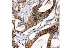 Anti-Laminin gamma 1 antibody, IHC(P) IHC(P): Human Intestinal Cancer Tissue (Laminin gamma 1 antibody  (C-Term))