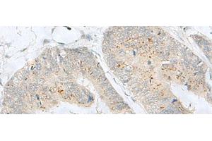 Immunohistochemistry of paraffin-embedded Human colorectal cancer tissue using MLNR Polyclonal Antibody at dilution of 1:35(x200) (Motilin Receptor antibody)