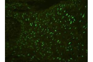 IF analysis of PHF21A using anti-PHF21A antibody (ABIN6719353) PHF21A was detected in paraffin-embedded section of human oesophagus squama cancer tissues. (PHF21A antibody  (AA 1-97))