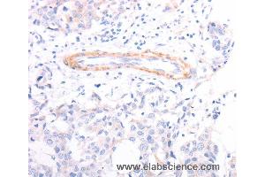 Immunohistochemistry of Human breast cancer using TPM1 Polyclonal Antibody at dilution of 1:40 (Tropomyosin antibody)