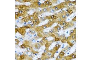 Immunohistochemical analysis of RPL9 staining in human liver cancer formalin fixed paraffin embedded tissue section. (RPL9 antibody)