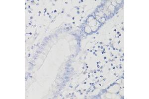 Immunohistochemistry of paraffin-embedded Human intestinal adenocarcinoma (negative control samples) using PD-L1/CD274/CD274 Rabbit mAb (ABIN7266181) at dilution of 1:200 (40x lens). (PD-L1 antibody  (Extracellular Domain))