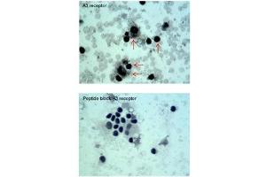 ADORA3 antibody staining of Oral Cell Carcinoma at a dilution of 5 ug/ml (Adenosine A3 Receptor antibody  (C-Term))