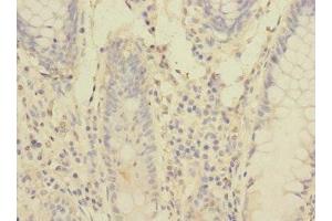 Immunohistochemistry of paraffin-embedded human colon cancer using ABIN7166553 at dilution of 1:100 (Protocadherin 1 antibody  (AA 60-220))