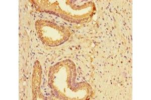 Immunohistochemistry of paraffin-embedded human prostate cancer using ABIN7158595 at dilution of 1:100 (LYPD2 antibody  (AA 23-103))