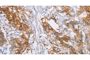 Immunohistochemistry of paraffin-embedded Human colon cancer tissue using CA9 Polyclonal Antibody at dilution 1:50 (CA9 antibody)