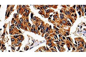 Immunohistochemistry of paraffin-embedded Human lung cancer tissue using IL13RA1 Polyclonal Antibody at dilution 1:50 (IL13 Receptor alpha 1 antibody)