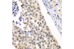 Immunohistochemistry of paraffin-embedded human lung cancer using HDAC2 antibody. (HDAC2 antibody  (C-Term))