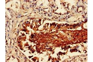 Immunohistochemistry of paraffin-embedded human lung cancer using ABIN7158291 at dilution of 1:100 (LAIR1 antibody  (AA 22-165))