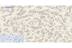 Immunohistochemistry of paraffin-embedded Human liver cancer tissue using TGFB1 Polyclonal Antibody at dilution of 1:200. (TGFB1 antibody)