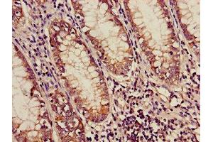 Immunohistochemistry of paraffin-embedded human colon cancer using ABIN7159169 at dilution of 1:100 (Medium-Chain Specific Acyl-CoA Dehydrogenase, Mitochondrial (AA 26-421) antibody)