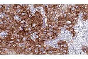 ABIN6277036 at 1/100 staining Human Head and neck cancer tissue by IHC-P. (CD94 antibody  (C-Term))