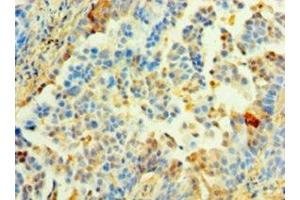 Immunohistochemistry of paraffin-embedded human lung cancer using ABIN7142344 at dilution of 1:100 (MRPL1 antibody  (AA 51-324))