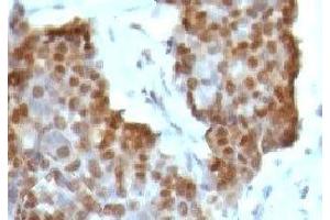 IHC testing of gastric carcinoma stained with Estrogen Receptor beta antibody (ESR2 antibody  (C-Term))