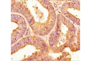 Immunohistochemistry of paraffin-embedded human endometrial cancer using ABIN7166456 at dilution of 1:100 (TPST2 antibody  (AA 26-377))