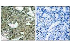 Immunohistochemical analysis of paraffin-embedded human breast carcinoma tissue using MEK1 (phospho- Ser221) antibody (E011161). (MEK1 antibody  (pSer221))