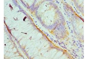 Immunohistochemistry of paraffin-embedded human colon cancer using ABIN7174029 at dilution of 1:100 (HCK antibody  (AA 1-220))
