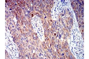 Immunohistochemical analysis of paraffin-embedded cervical cancer tissues using P2RY4 mouse mAb with DAB staining. (P2RY4 antibody)