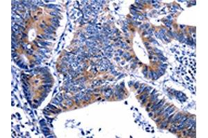 The image on the left is immunohistochemistry of paraffin-embedded Human colon cancer tissue using ABIN7129604(GIP Antibody) at dilution 1/13, on the right is treated with fusion protein. (GIP antibody)