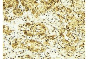 ABIN6269095 at 1/100 staining Human breast cancer tissue by IHC-P. (C-JUN antibody  (Internal Region))