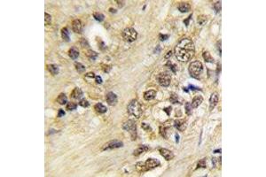 IHC analysis of FFPE human prostate carcinoma tissue stained with Myc antibody (c-MYC antibody  (AA 36-65))