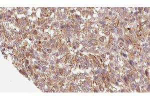 ABIN6279229 at 1/100 staining Human Melanoma tissue by IHC-P. (CALML3 antibody  (Internal Region))