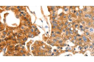 Immunohistochemistry of paraffin-embedded Human lung cancer using MVP Polyclonal Antibody at dilution of 1:30 (MVP antibody)