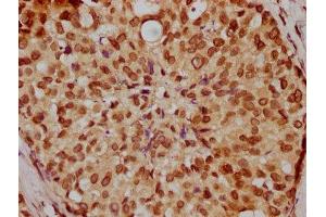 IHC image of ABIN7164247 diluted at 1:200 and staining in paraffin-embedded human breast cancer performed on a Leica BondTM system. (Lamin A/C antibody  (AA 385-572))