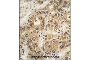 Formalin-fixed and paraffin-embedded human hepatocarcinoma tissue reacted with ZIC3 antibody (N-term) (ABIN389243 and ABIN2839388) , which was peroxidase-conjugated to the secondary antibody, followed by DAB staining. (ZIC3 antibody  (N-Term))