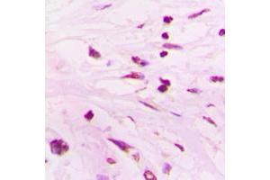 Immunohistochemical analysis of SUPT3H staining in human lung cancer formalin fixed paraffin embedded tissue section. (SUPT3H/SPT3 antibody  (Center))