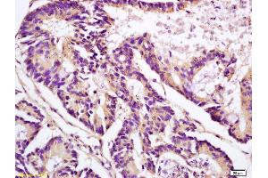 Formalin-fixed and paraffin embedded human colon carcinoma labeled with Anti-APOJ/Clusterin Polyclonal Antibody, Unconjugated (ABIN685342) at 1:200 followed by conjugation to the secondary antibody and DAB staining (Clusterin antibody  (AA 331-449))