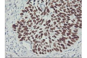 Immunohistochemical staining of paraffin-embedded Carcinoma of Human lung tissue using anti-TP53 mouse monoclonal antibody. (p53 antibody)