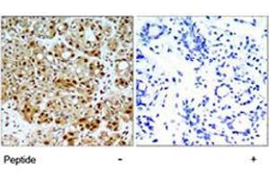 Immunohistochemical analysis of paraffin-embedded human breast carcinoma tissue using HSP90AB1 polyclonal antibody  . (HSP90AB1 antibody)