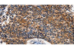 Immunohistochemistry of paraffin-embedded Human lung cancer using HK2 Polyclonal Antibody at dilution of 1:60 (Hexokinase 2 antibody)