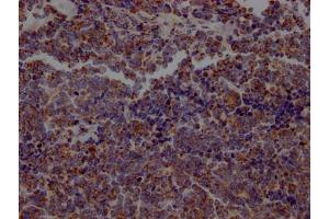 IHC image of ABIN7127319 diluted at 1:100 and staining in paraffin-embedded human lung cancer performed on a Leica BondTM system. (Recombinant ACO2 antibody)