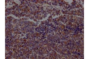 IHC image of ABIN7127319 diluted at 1:100 and staining in paraffin-embedded human lung cancer performed on a Leica BondTM system.