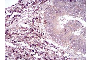 Immunohistochemical analysis of paraffin-embedded rectum cancer tissues using CD6 mouse mAb with DAB staining. (CD6 antibody  (AA 18-199))