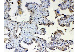 IHC analysis of ETV6/Tel using anti-ETV6/Tel antibody . (ETV6 antibody  (AA 327-448))