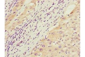 Immunohistochemistry of paraffin-embedded human liver cancer using ABIN7172660 at dilution of 1:100 (GTF2A2 antibody  (AA 1-109))